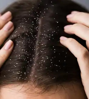 Tough Dandruff Removal: