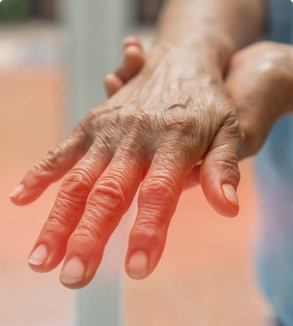 Rheumatoid Arthritis Relief: